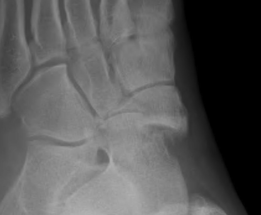 Displaced Navicular Fracture